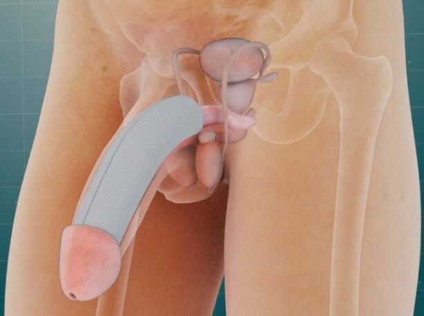 The penis after the introduction of a special implant under the skin. 