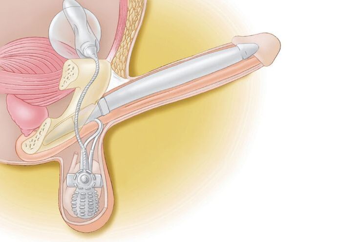 penile enlargement prosthesis